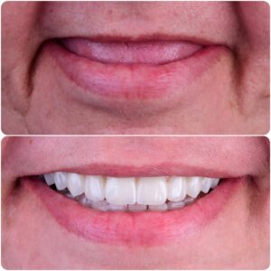 POR QUE OS PACIENTES PODEM OPERAR IMPLANTES DENTÁRIOS ZIGOMÁTICOS EM NATAL-RN, PRINCIPALMENTE OS MAIS IDOSOS?