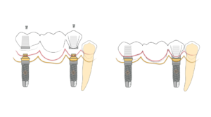 Ilustração comparando prótese fixa sobre implantes e prótese sobre dente natural