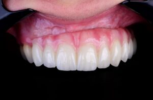 Ninguém acorda querendo implantes.