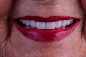 Odontologia da Longevidade: Como Garantir Seus Dentes Naturais Pelo Maior Tempo Possível