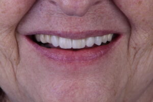 Quando o dente cai, não é só o dente que desaba