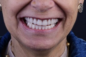 5 sinais de que sua dentadura está te envelhecendo (e o que fazer sobre isso)
