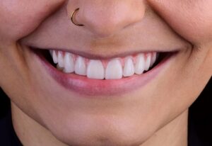 Dentes Fixos em 2 Dias: Quando a Carga Imediata é Real