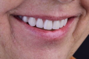 Primeiro Implante Dentário Robotizado: o Futuro da Odontologia Chegou