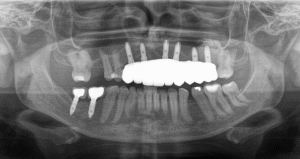 Radiografia panorâmica mostrando implantes dentários instalados nos maxilares