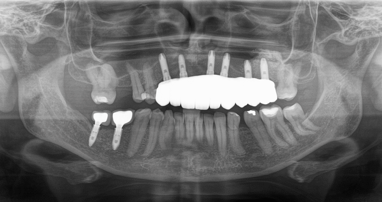 Radiografia panorâmica mostrando implantes dentários instalados nos maxilares