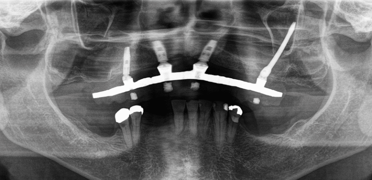 Radiografia panorâmica mostrando implantes zigomáticos ancorados no osso zigomático
