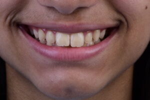 Prevenção com Propósito: Por que Cuidar da Saúde Bucal é uma Decisão de Qualidade de Vida