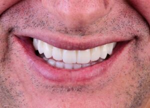 Implantes Zigomáticos: a solução moderna para quem não tem osso e quer voltar a sorrir com segurança