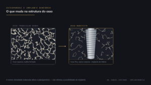 Comparação entre osso trabecular denso e osso rarefeito com um implante dentário de titânio, representando osteoporose e implante dentário
