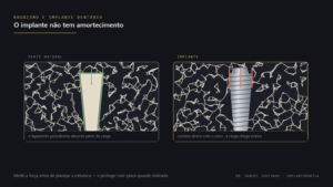 Comparação entre dente natural com ligamento periodontal e implante dentário, mostrando os vetores de força mastigatória do bruxismo
