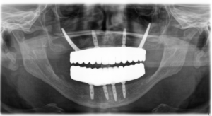 Prótese Dentária ou Implante: Qual a Diferença?