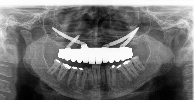 Radiografia panorâmica mostrando implantes zigomáticos instalados