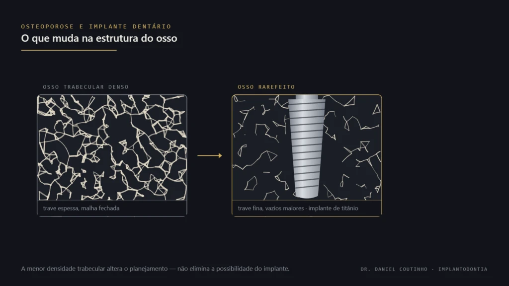 Comparação entre osso trabecular denso e osso rarefeito com um implante dentário de titânio, representando osteoporose e implante dentário