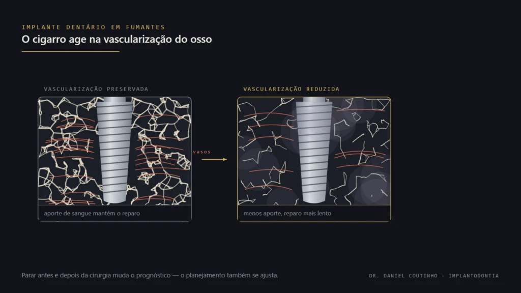 Comparação entre osso com vascularização preservada e osso com vascularização reduzida ao redor de um implante dentário, representando o efeito do cigarro