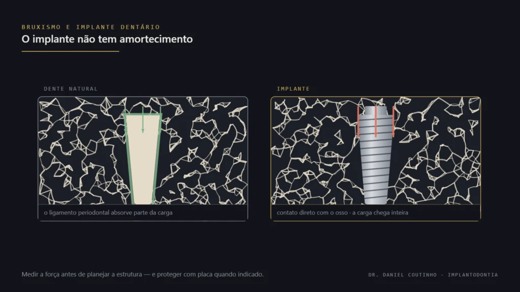 Comparação entre dente natural com ligamento periodontal e implante dentário, mostrando os vetores de força mastigatória do bruxismo