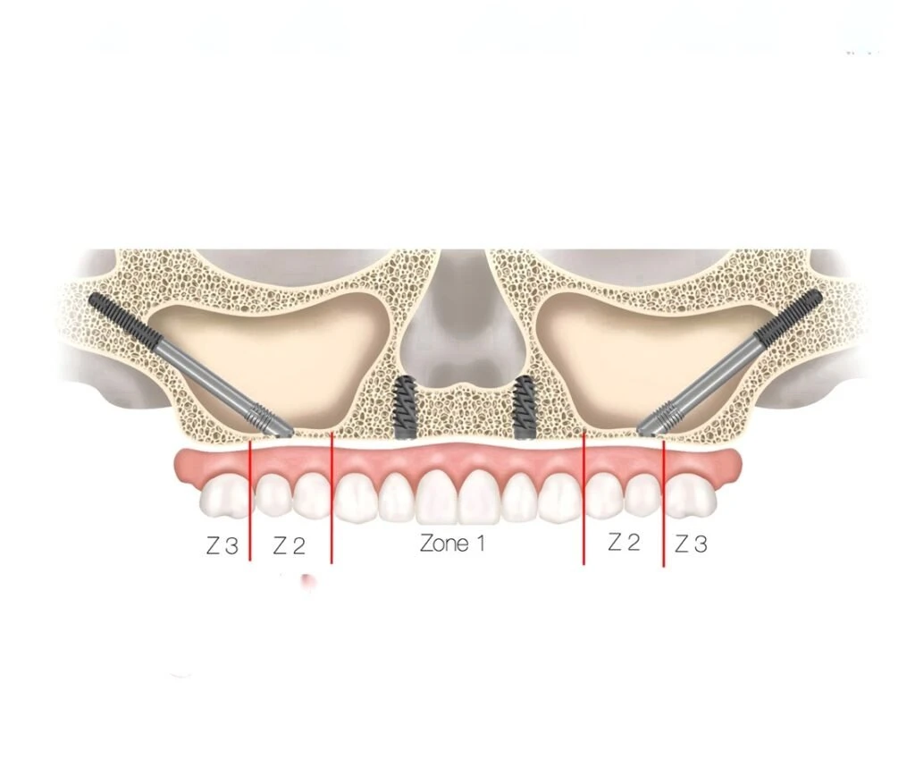 Riscos da cirurgia de implantes zigomáticos: desafios anatômicos