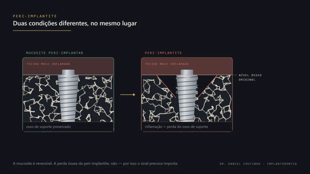 Esquema comparativo: à esquerda, mucosite peri-implantar, com inflamação apenas no tecido mole e osso de suporte preservado; à direita, peri-implantite, com inflamação e perda do osso ao redor do implante, indicando o nível ósseo original