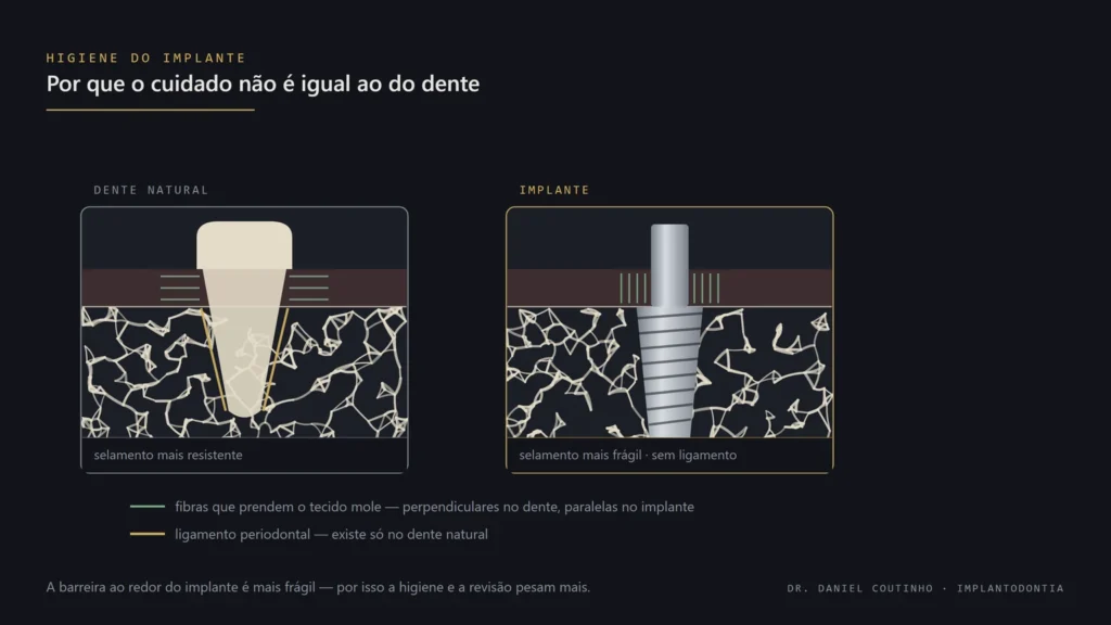 Comparação entre dente natural e implante dentário mostrando a inserção do tecido mole: no dente as fibras são perpendiculares e há ligamento periodontal; no implante as fibras são paralelas e não há ligamento, resultando em selamento mais frágil