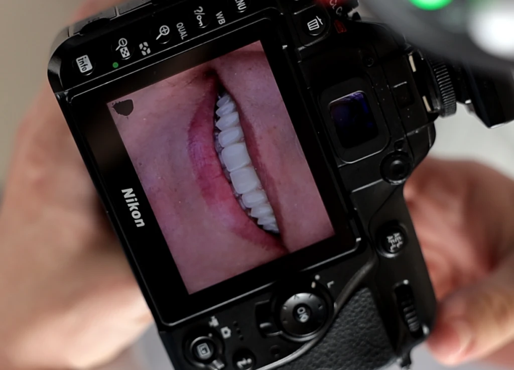 Implante dentário e qualidade de vida: voltar a mastigar e sorrir