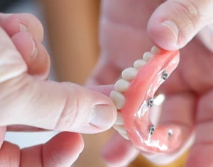 Mãos segurando uma prótese removível com encaixes para implantes