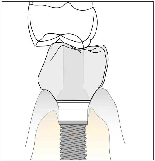 Benefícios do implante dentário além da estética: função e convívio