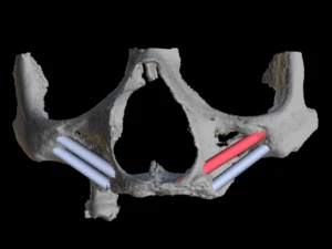 Reconstrução do terço médio da face mostrando implantes zigomáticos ancorados no osso malar