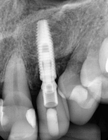 implantes dentários em um dia — cirurgia guiada e carga imediata em Natal-RN