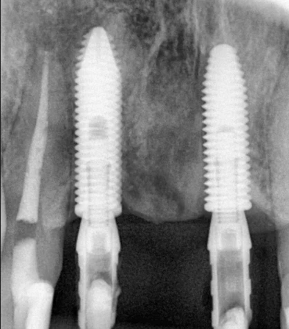 implantes dentários em um dia — cirurgia guiada e carga imediata em Natal-RN
