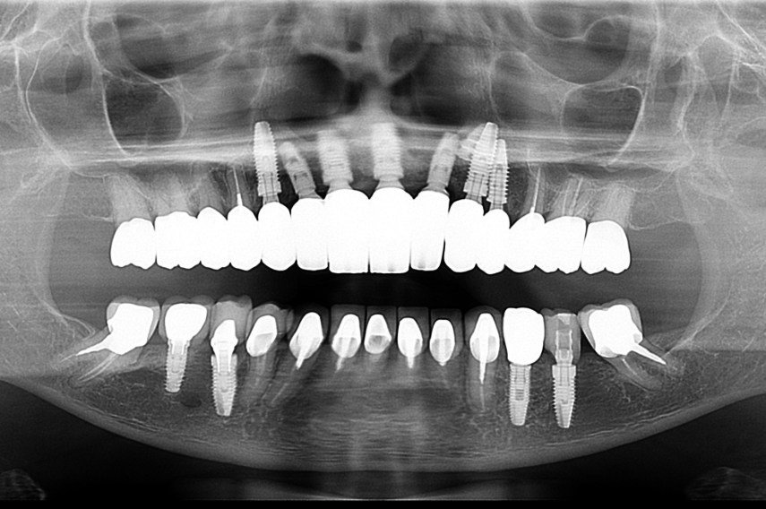 Radiografia panorâmica de acompanhamento: implantes osseointegrados em função, o que define quanto tempo dura um implante